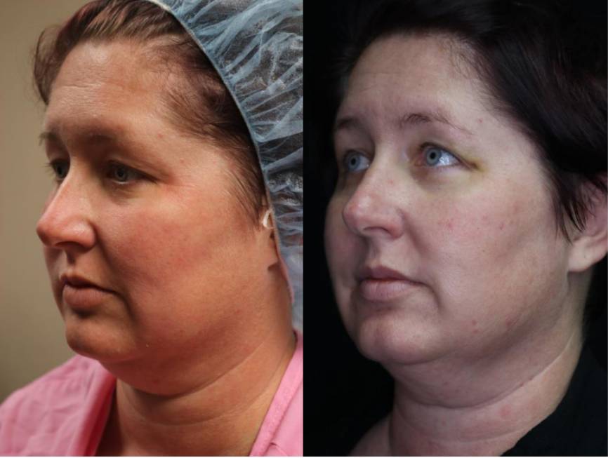 Morpheus8 full face and neck before and after