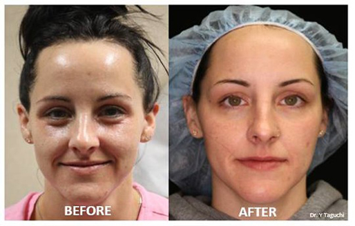 Morpheus8 before and after, 2 treatments