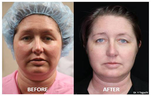 Morpheus8 before and after, 2 treatments